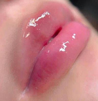 Hydra Lips