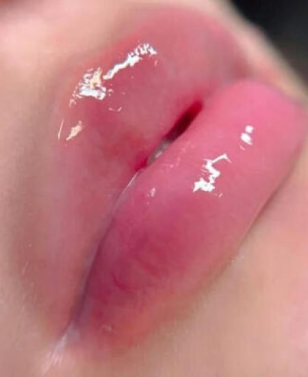 Hydra Lips